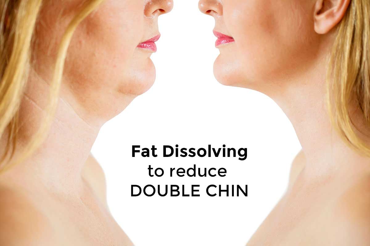 Fat Dissolving Aesthetics Julie Edwards