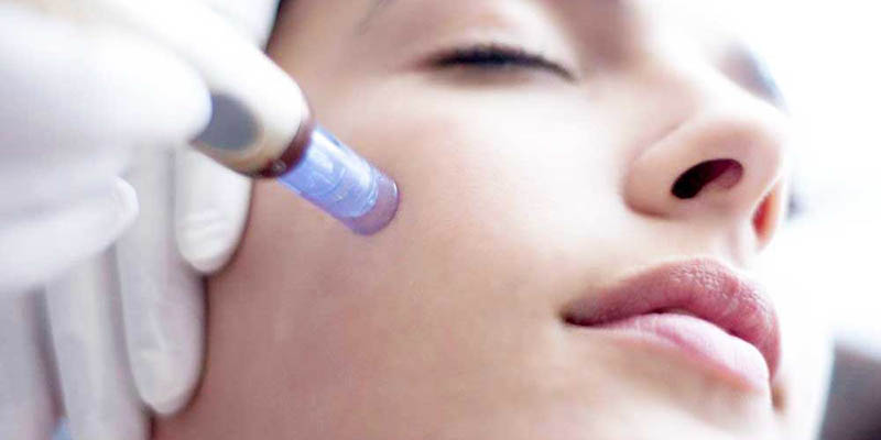 Microneedling For Anti-Ageing