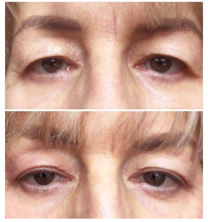 Non surgical eyelift deals
