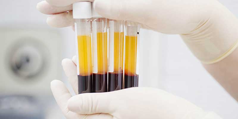 Platelet Rich Plasma, PRP